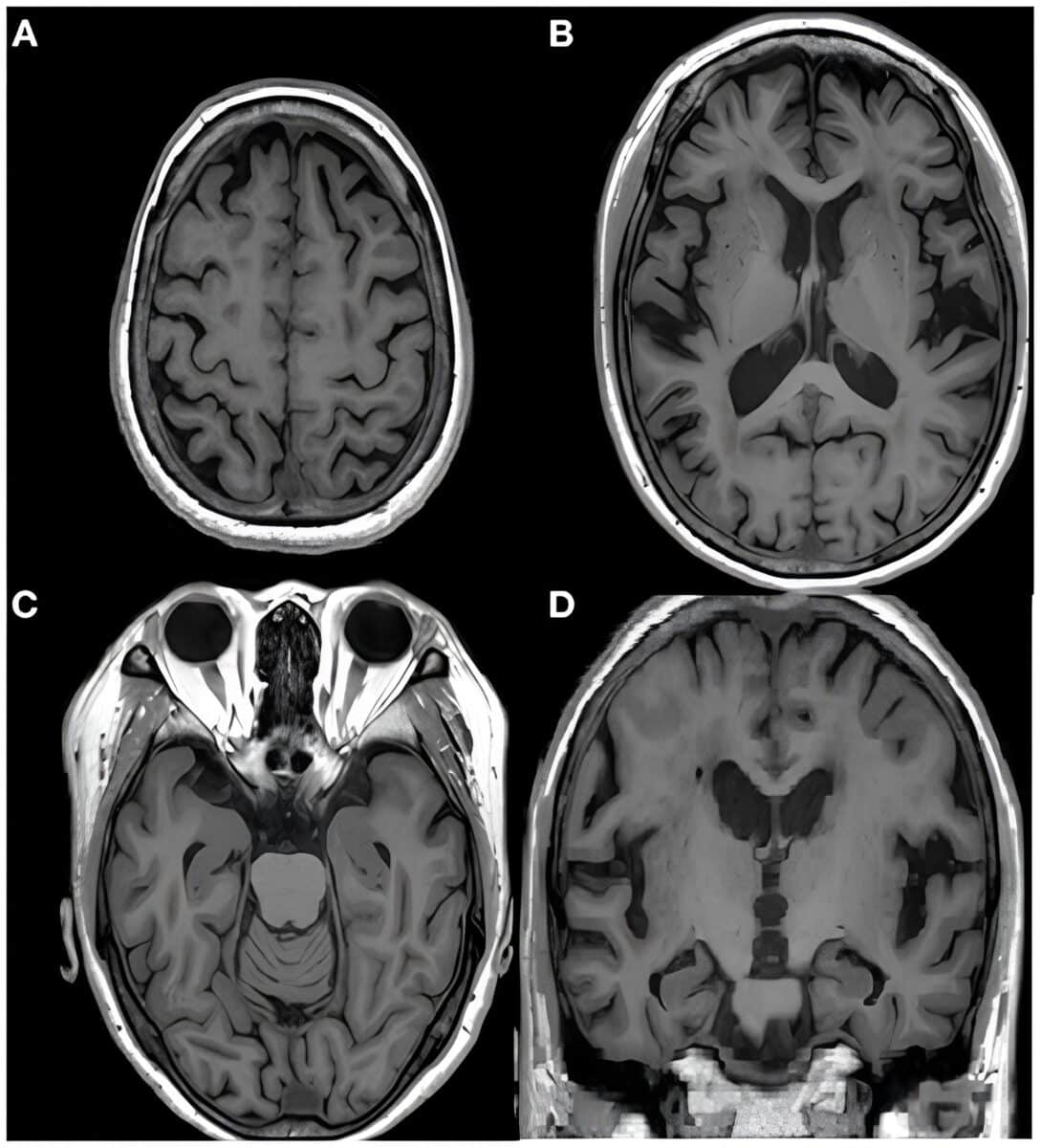 МРТ головного мозга другой пациентки с эротоманией / © Frontiers