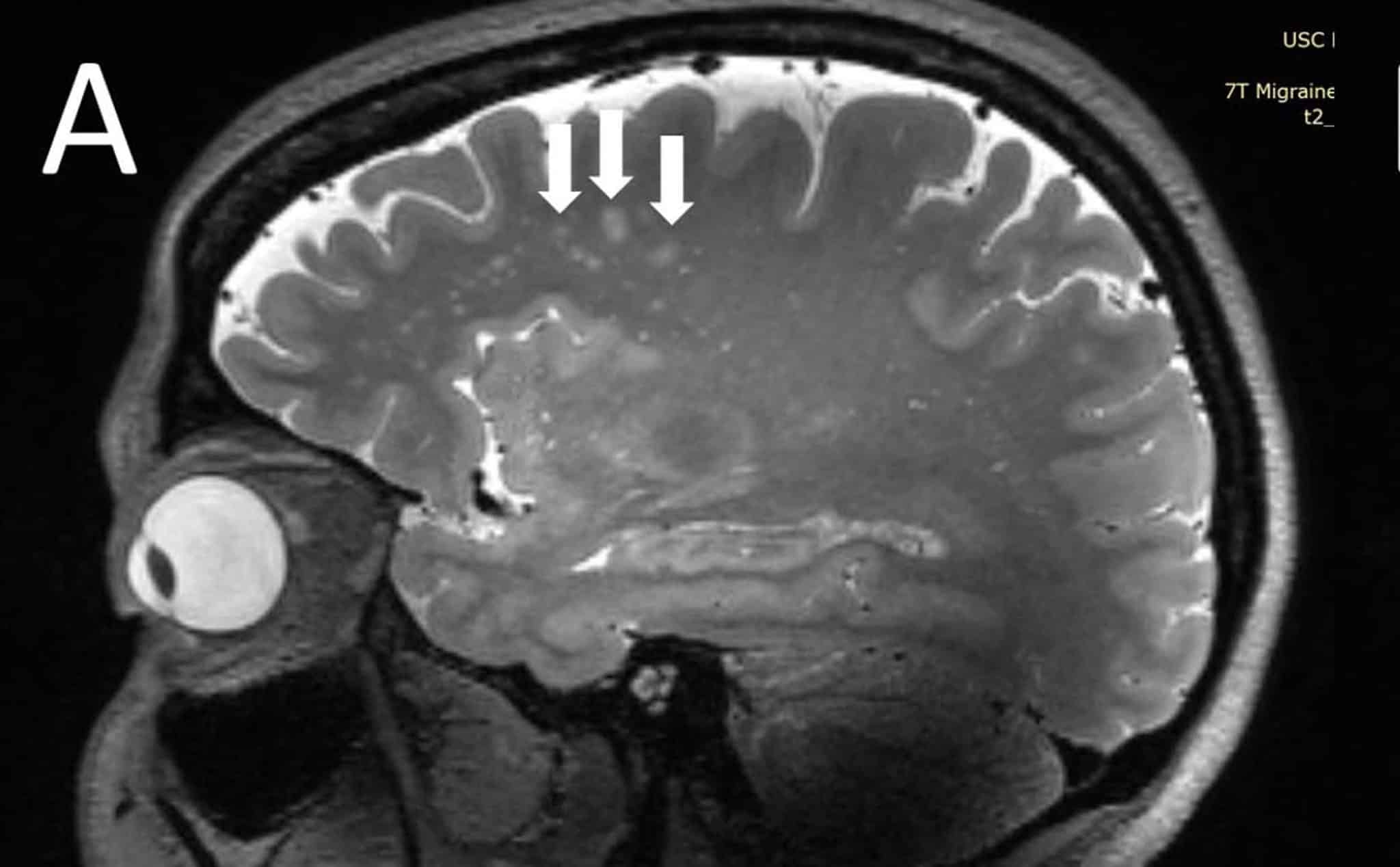 Изменения в мозге при мигрени / © RSNA and Wilson Xu