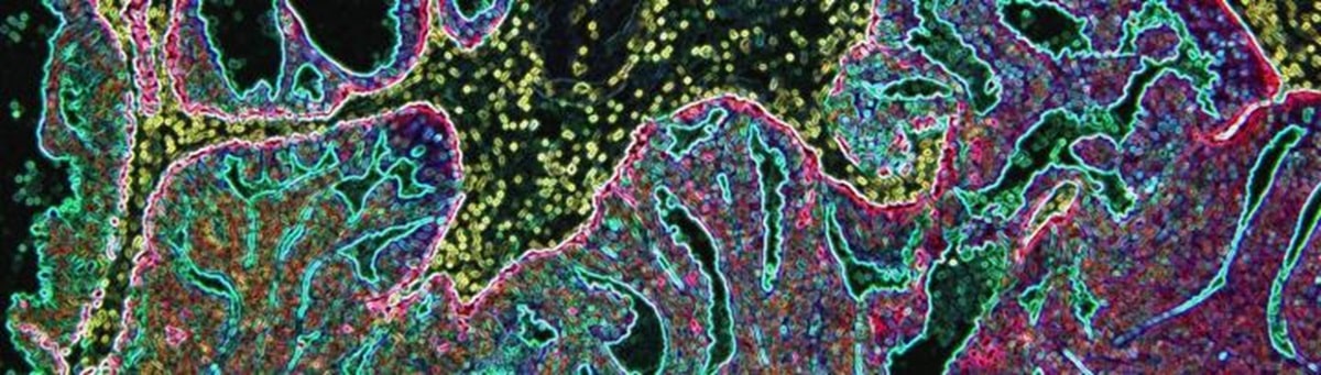 Снимок ткани пациента, носителя BRCA2, с раком простаты / © Monash University