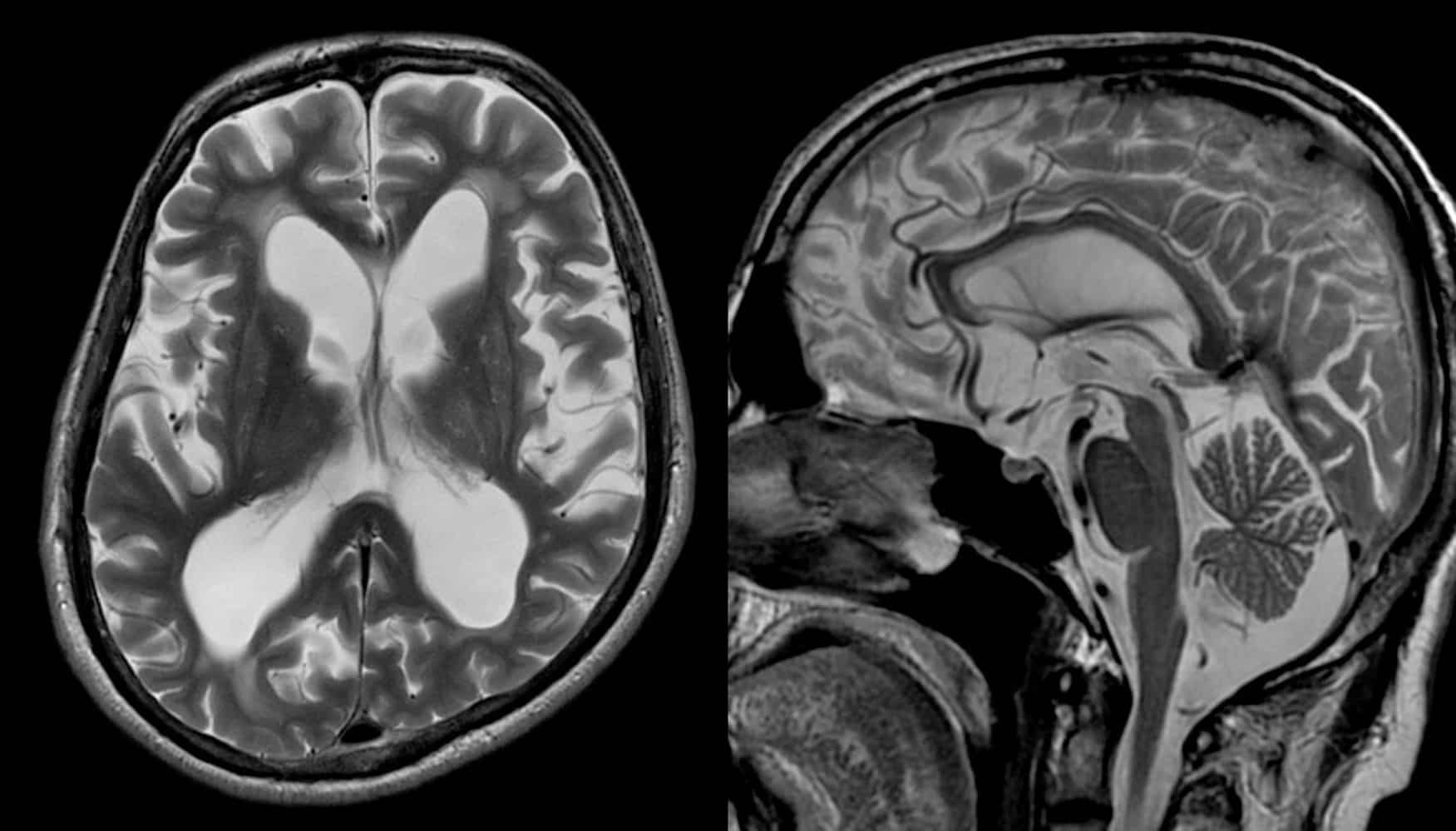 Увеличенные желудочки головного мозга пациента с гидроцефалией на МРТ / © neuroradiologycases.com, Balaji Anvekar