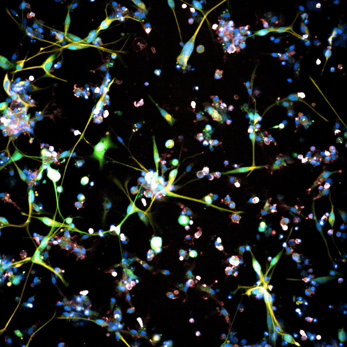 Клетки смертельной опухоли мозга — глиобластомы / © Sohyon Lee and Berend Snijeder / ETH Zurich