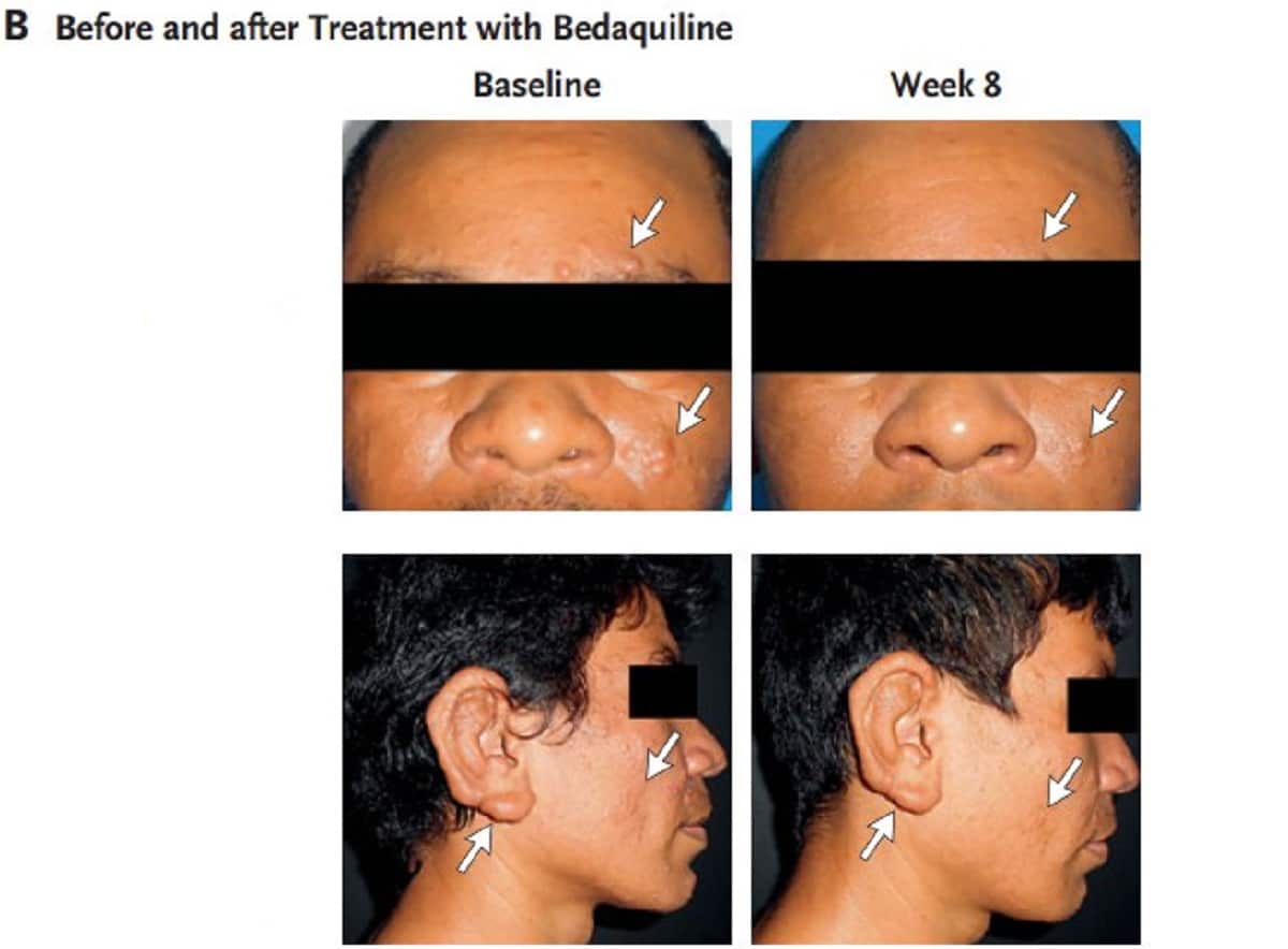 Антибиотик бедаквилин, помогающий при туберкулезе, остановил проказу / © Jaison Barreto et al., The New England Journal of Medicine