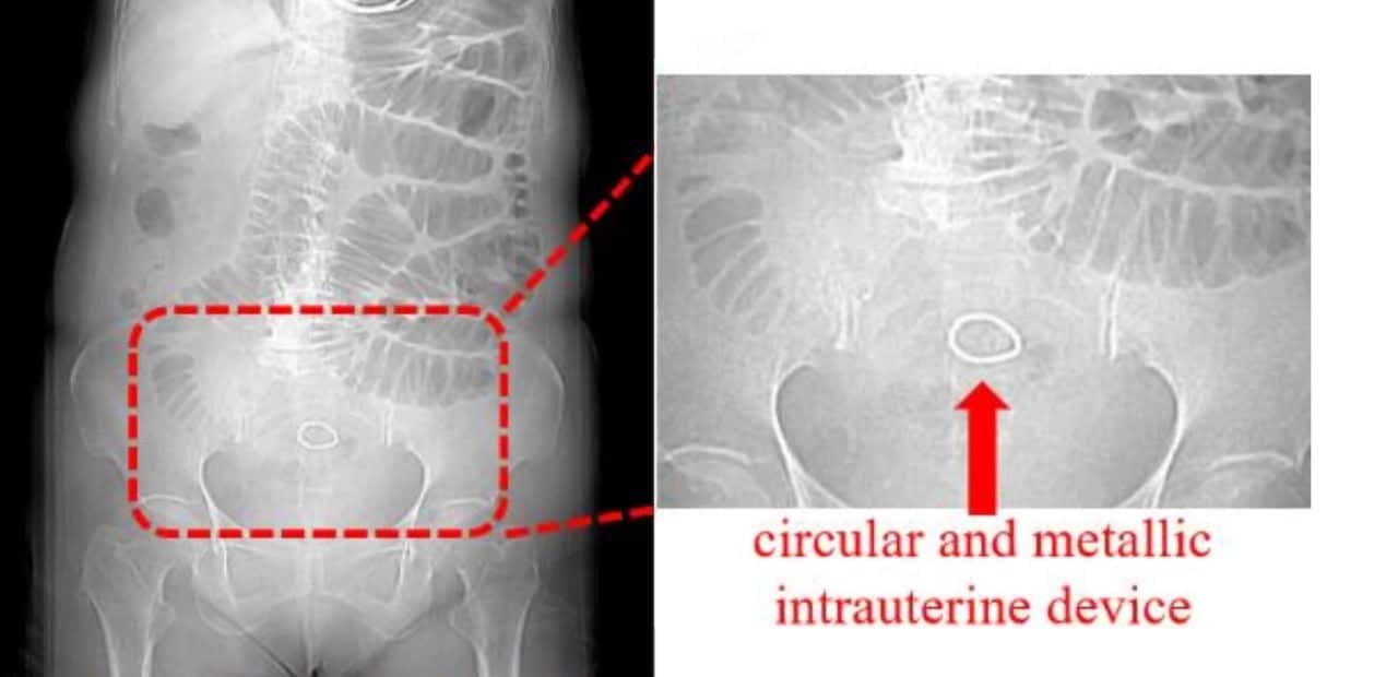 На снимке видно металлическое кольцо в полости малого таза пациентки. Стрелка указывает на кольцеобразную внутриматочную спираль / © Zheng, K., Zhang, Q., Wang, T. et al., BMC Women's Health (2025)