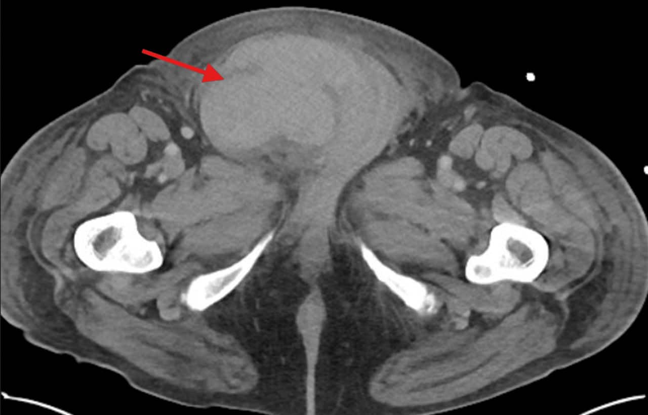 Образование гематомы в дистальном отделе правого пахового канала (красная стрелка) / © Steven J. Laxton, Jackie Dovgalyuk, Cureus