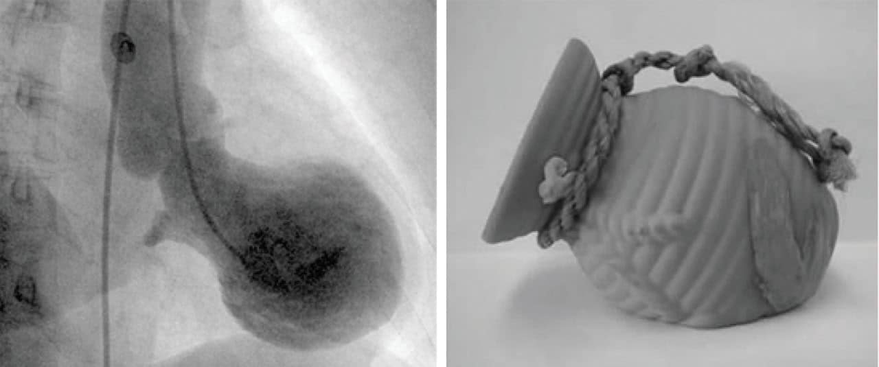 Рентгеновский снимок сердца человека со стрессовой кардиомиопатией (слева) и горшок для ловли осьминогов (такоцубо), используемый рыбаками в Японии (справа) / © Bilal Saeed, M.D., University of Toledo Medical Center, Toledo, Ohio; Satoshi Kurisu, M.D., Hiroshima City Hospital, Hiroshima, Japan.