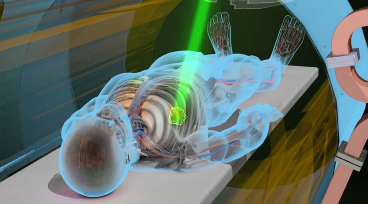 Лучевая терапия в представлении художника / © ronc.ru