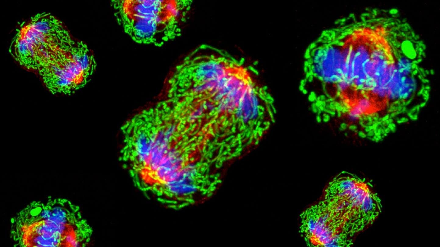 Клетки трижды негативного рака груди в представлении художника / © mdanderson.org