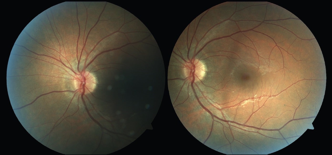 Глаз и слепое пятно / Zurab Glonti et al./retinatoday.com