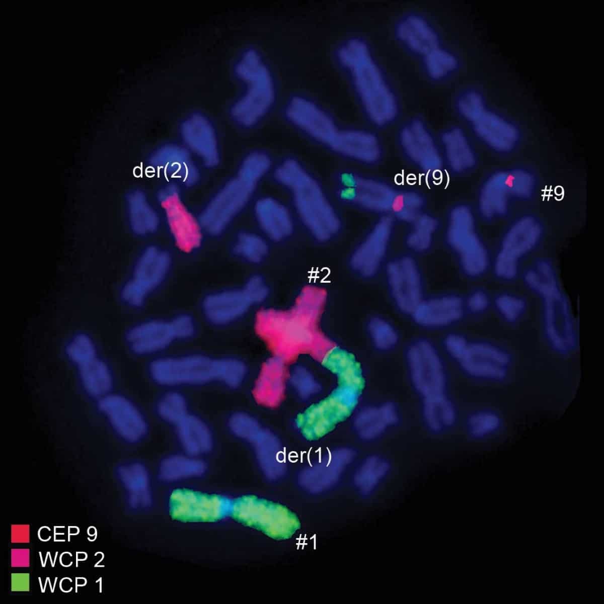 Хромосомные транслокации. Фотография, полученная методом FISH / © Walid Al-Achkar et al., Oncology Letters, 2010
