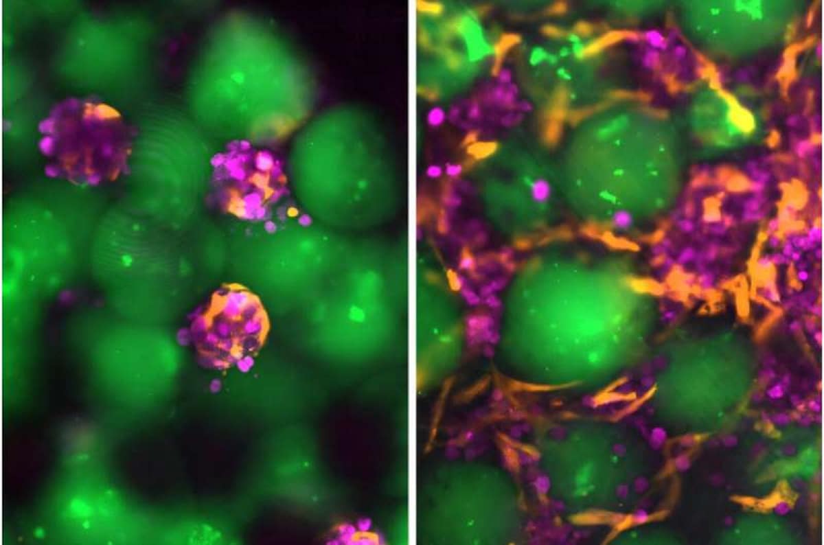Новый препарат для инъекций содержит клетки печени (фиолетовые), микросферы гидрогеля (зеленые) и поддерживающие клетки фибробласты (оранжевые) / © Автор неизвестен, Bhatia Lab