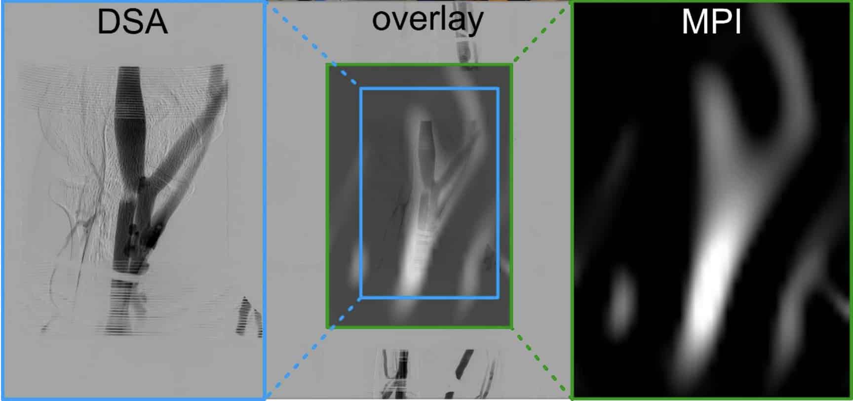 Два метода визуализации вен руки в сравнении: слева традиционная рентгеновская ангиография (DSA), справа — магнитно-частичная томография (MPI). В центре — наложение снимков, демонстрирующее, что новый метод отображает те же сосуды, что и рентген, но без ионизирующего излучения. / © Patrick Vogel (2026)
