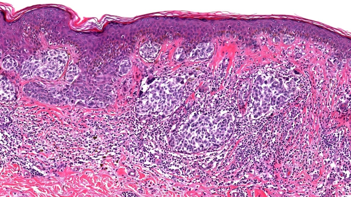 Клетки меланомы / © Michele Donati, Pathology Outlines